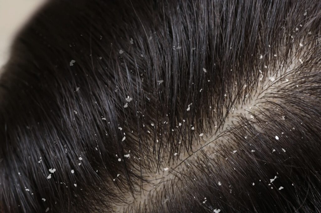 Dry Scalp vs Dandruff