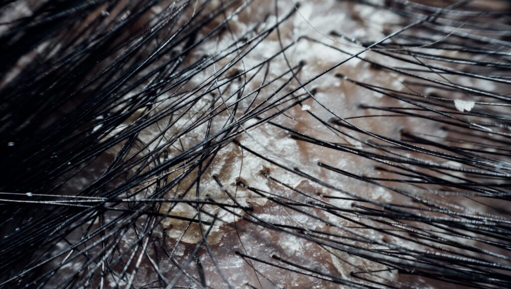 dry scalp vs dandruff: how to tell the difference