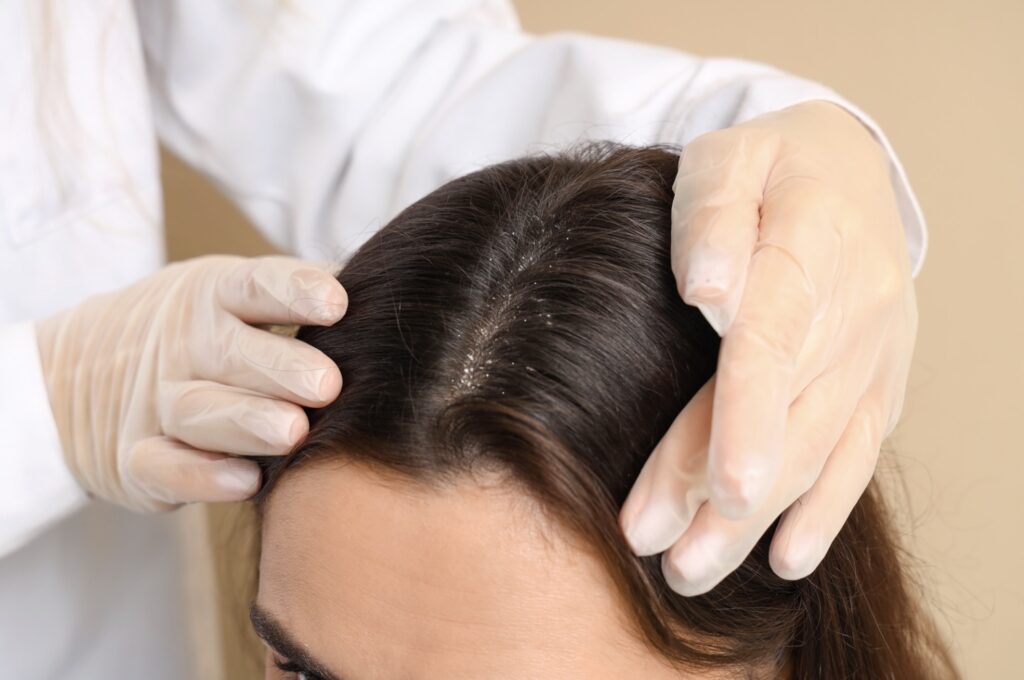 dry scalp vs dandruff professional care